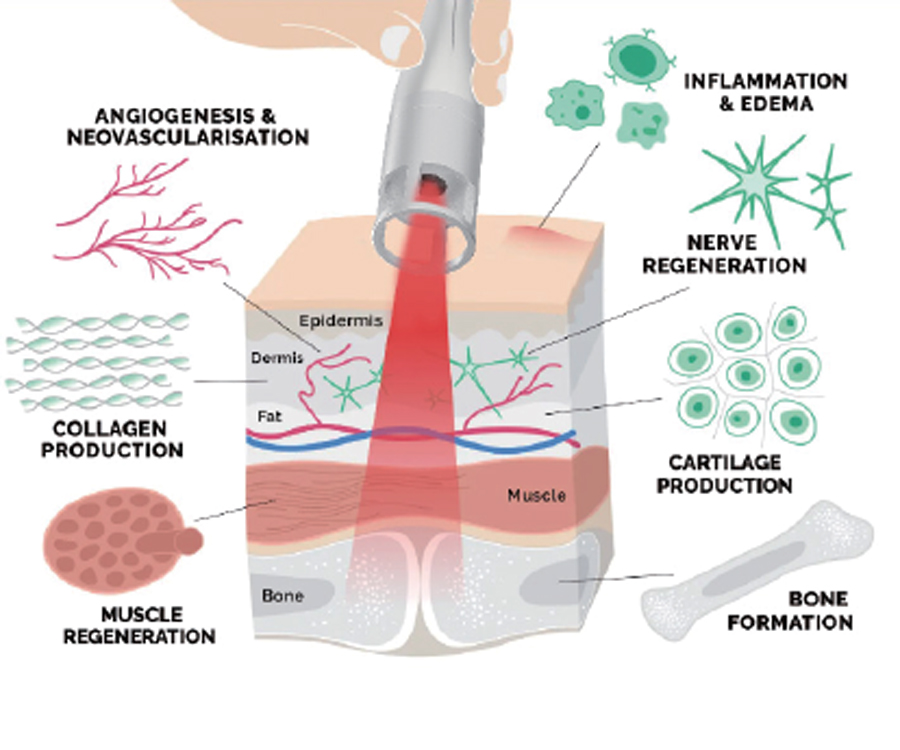 High Power Laser Therapy